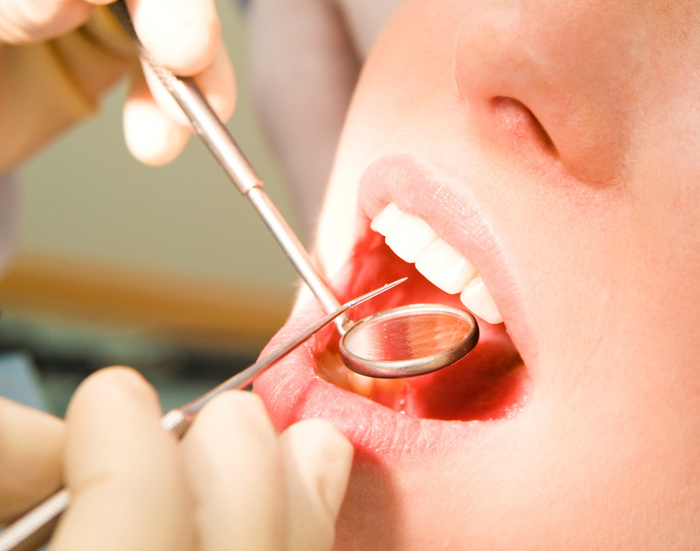 Teeth Extraction