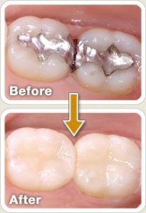 Tooth Colored Restoration